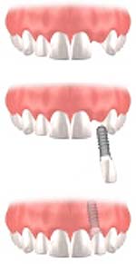 Missing Single Tooth