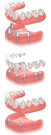 Completely Toothless Jaw